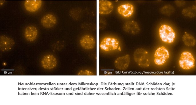 Neuroblastomzellen unter dem Mikroskop. Die Färbung stellt DNA-Schäden dar, je intensiver, desto stärker und gefährlicher der Schaden. Zellen auf der rechten Seite haben kein RNA-Exosom und sind daher wesentlich anfälliger für solche Schäden.