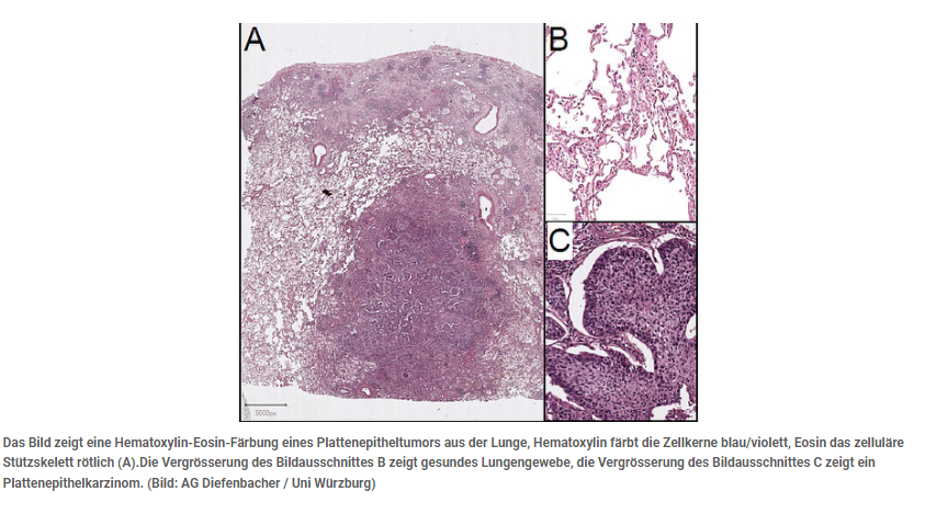 Hematoxylin-Eosin-Färbung eines Plattenepitheltumors aus der Lunge, Hematoxylin färbt die Zellkerne