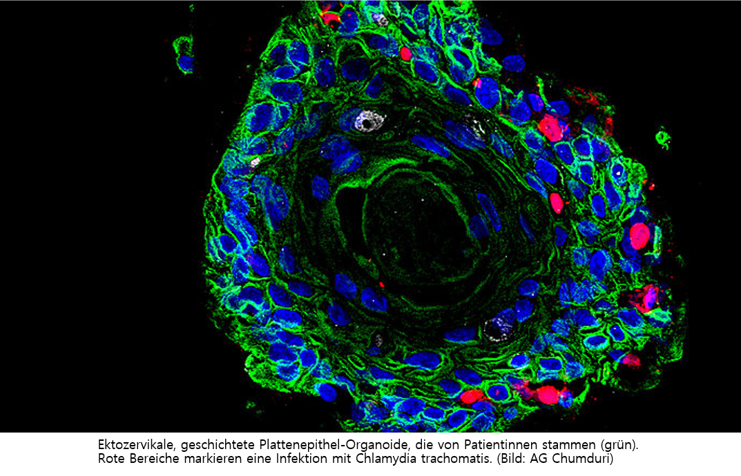 Ektozervikale, geschichtete Plattenepithel-Organoide, die von Patientinnen stammen (grün). Rote Bereiche markieren eine Infektion mit Chlamydia trachomatis. (Bild: AG Chumduri)